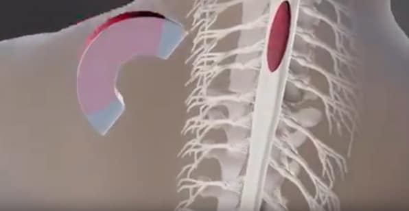 脊髄に注入した抗ガン剤を、磁石によって患部に誘導するイメージ映像。